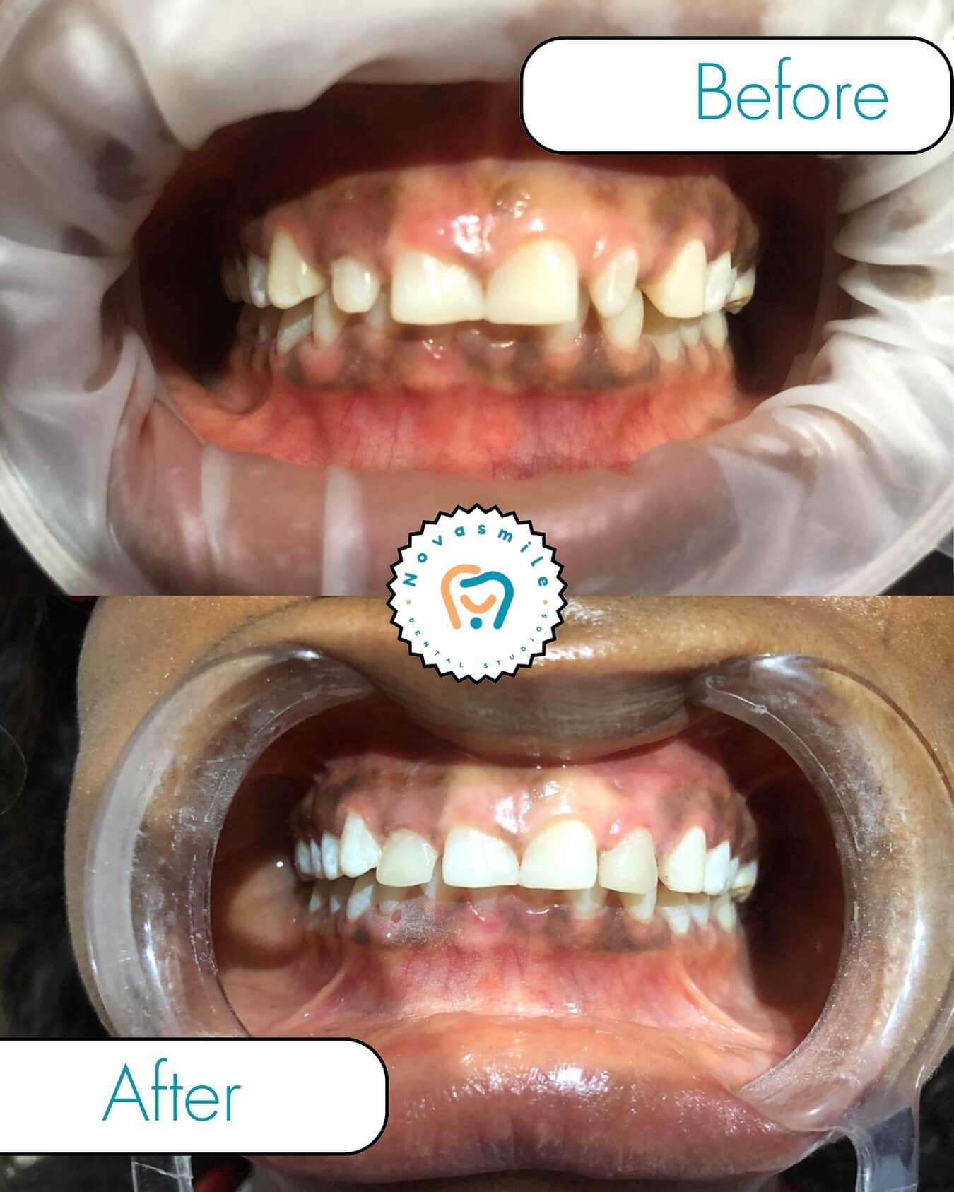Before and after teeth